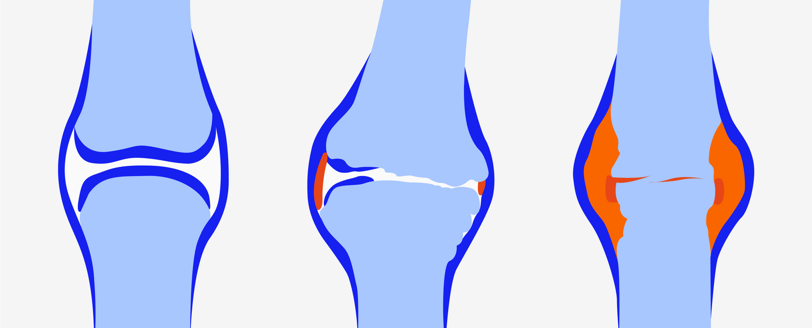 Arthritis and Insoles: Understanding the Connection to Foot Health and Pain Relief