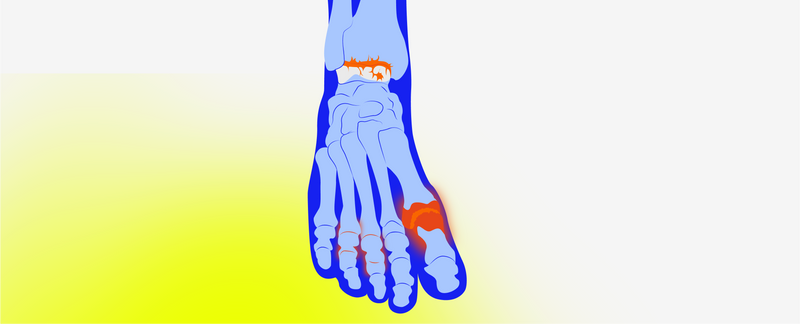 Insoles for Elderly Footcare