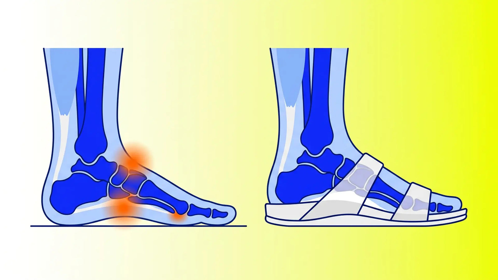 Flat-feet support illustration showing collapsed arch pressure versus stable supported alignment in summer footwear