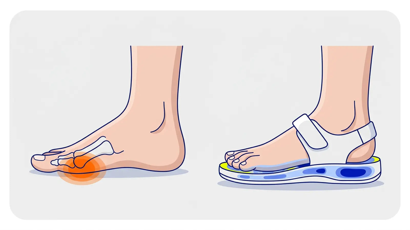 Metatarsalgia forefoot pressure comparison between overloaded foot and supportive sandal alignment