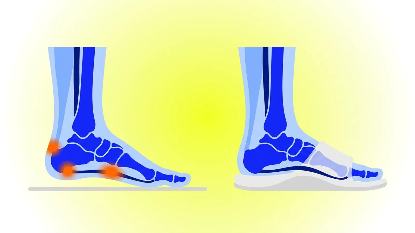 Plantar fasciitis support illustration showing repeated heel-and-arch tension on a hard flat surface versus reduced fascia load in supportive summer footwear