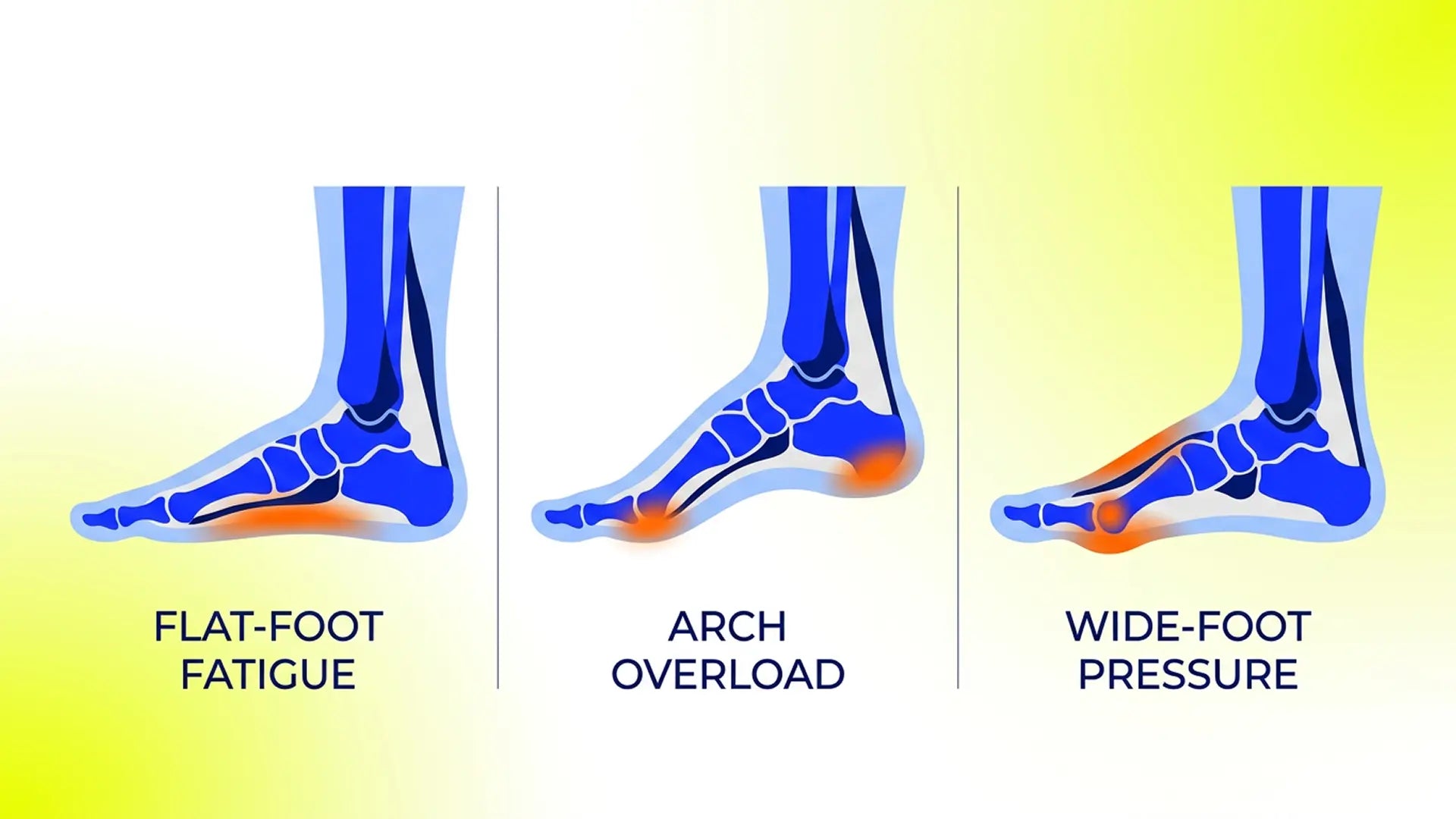 Vector comparison of flat feet, high load arch strain, and wide-foot pressure