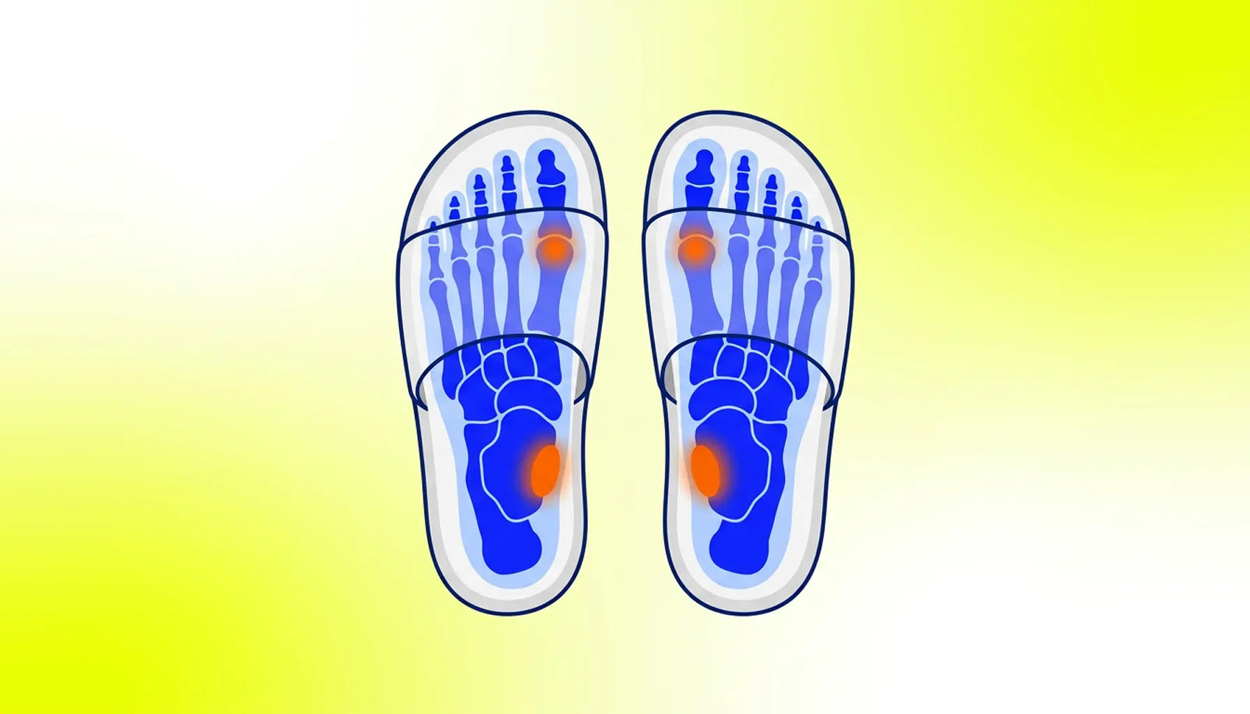 Are Recovery Slides Good for Plantar Fasciitis? Biomechanical Criteria default cover image